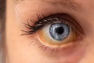 Olhos amarelos: possíveis causas e como tratar Olhos amarelos: possíveis causas e como tratar