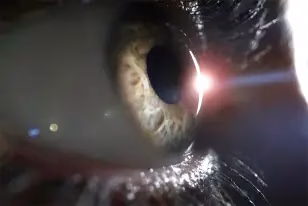 Tratamento Cirurgia Lasik Tratamento Cirurgia Lasik