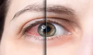 Infeções oculares causados por estreptococos Infeções oculares causados por estreptococos